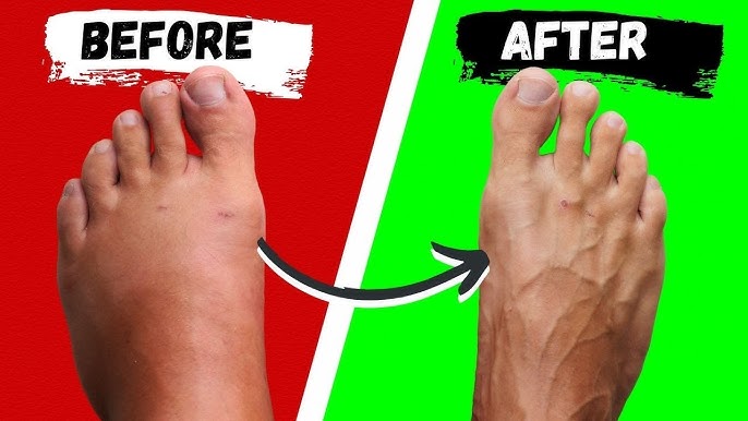 Best ways to reduce swelling in feet overnight
