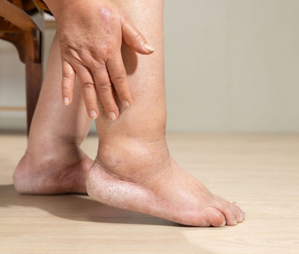 The Reason Your Legs Swell after Sitting All Day